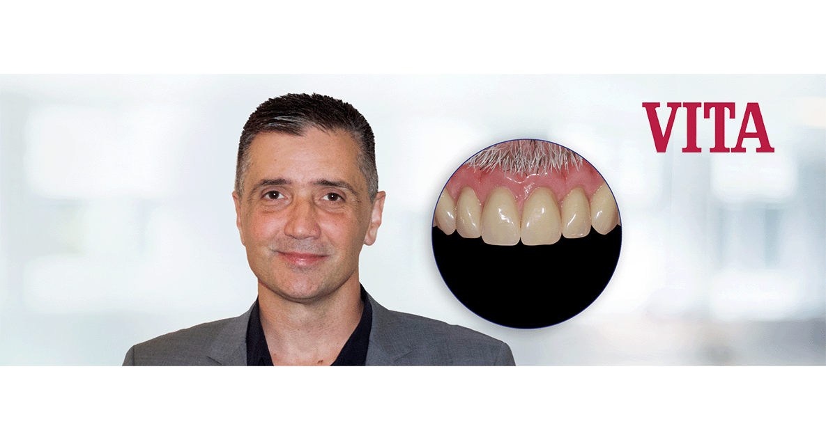 VITA MFT: Cost-effective partial dentures in a variety of shapes and shades